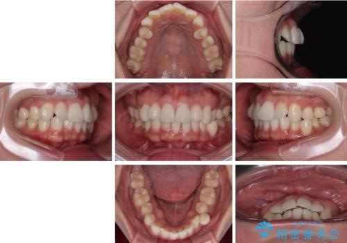 デコボコと正中のずれを改善した矯正治療の治療前