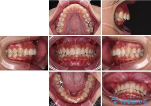 抜歯矯正で口が閉じやすく|ディープバイトと叢生を改善した症例の治療前