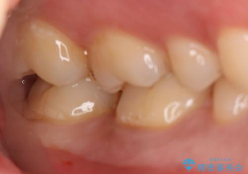 奥歯を良いもので治したい　セラミックインレーの治療前