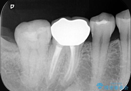 【セラミックインレー】歯の奥側に虫歯ができてしまったの治療前