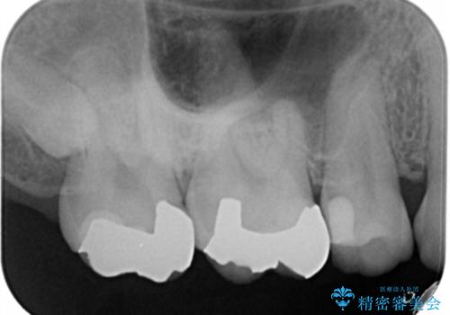 銀歯を金歯にしたい　ゴールドインレーの治療後