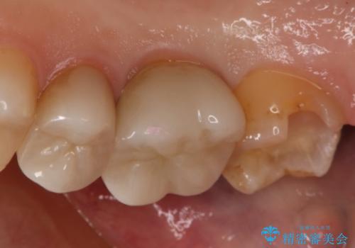 銀歯をやり変えたい　セラミックインレーの治療中