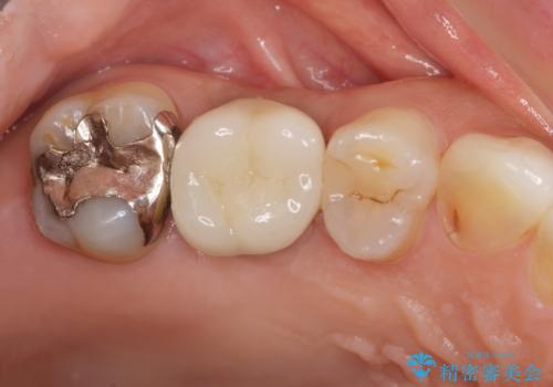 [ 奥歯の欠損 ] インプラントを用いた咬合機能の回復の治療後