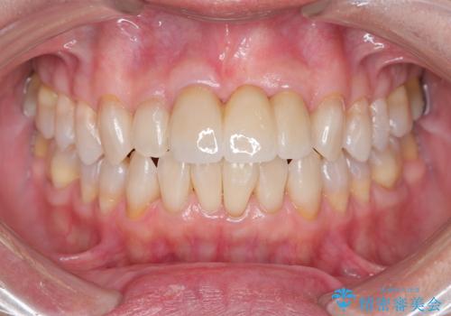 [ 欠損部の著しい骨欠損 ]　歯ぐきのボリュームを回復し自然なブリッジ作製治療の治療後