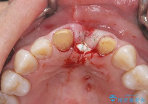 [ 欠損部の著しい骨欠損 ]　歯ぐきのボリュームを回復し自然なブリッジ作製治療の治療中