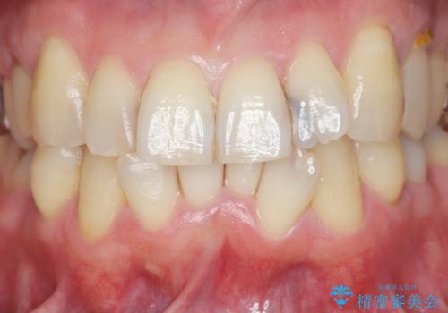 前歯の歯間に発生した虫歯のセラミック治療の治療前