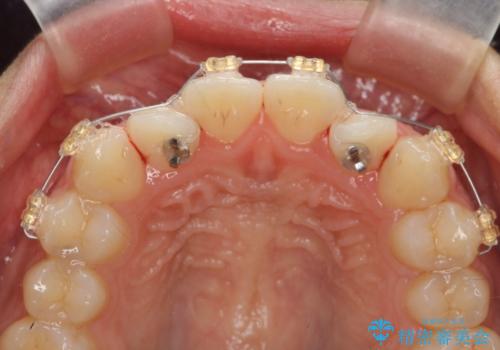 前歯のねじれ、すれ違いを改善 部分ワイヤー+マウスピース矯正の治療前