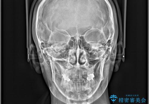 開咬・叢生(八重歯)を抜歯矯正で改善|ワイヤー矯正(クリア装置)症例の治療後