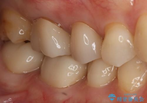 銀歯をやり変えたい セラミックインレーの治療後