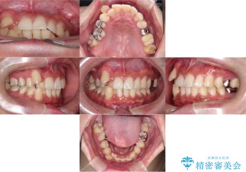 【ワイヤー矯正】八重歯と下の歯の凸凹を治したいの治療前