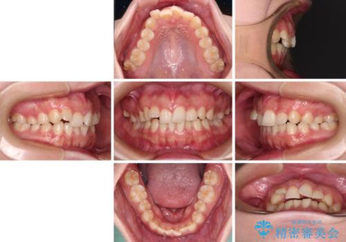 捻れて前に出ている前歯　ワイヤー装置での非抜歯矯正の治療前