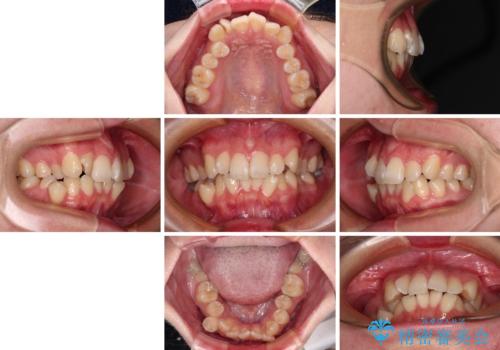 デコボコだらけの歯列をきれいに ワイヤー装置での抜歯矯正治療の治療前