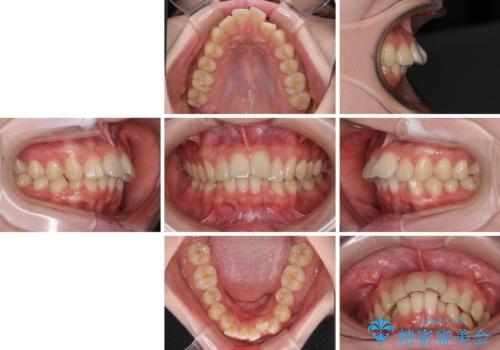 深い咬み合わせと飛び出した前歯　ワイヤー装置での抜歯矯正治療の治療前
