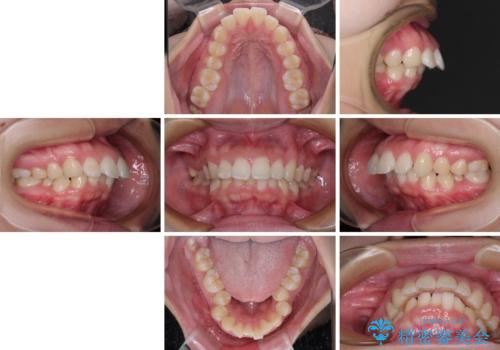 唇が閉じられない　ワイヤー装置による抜歯矯正治療の治療前