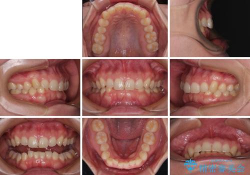 隠れた前歯が気になる　ディープバイトのワイヤー矯正治療の治療前