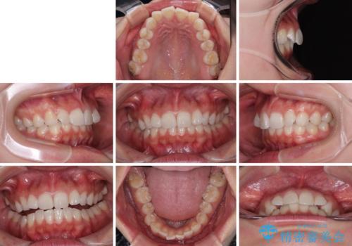 デコボコと咬み合わせを改善 インビザライン矯正治療の治療前