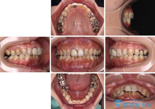 むし歯治療とインビザライン矯正治療 総合歯科治療で整った口腔内にの治療前