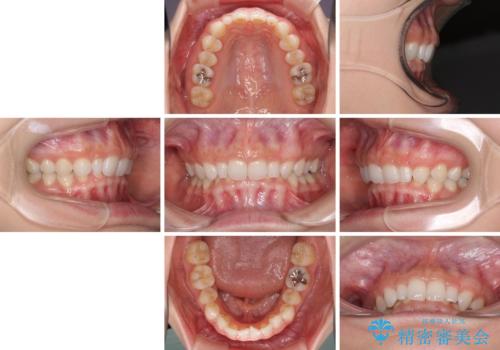 前歯のデコボコと小さい歯を改善 インビザラインとオールセラミッククラウンの治療前