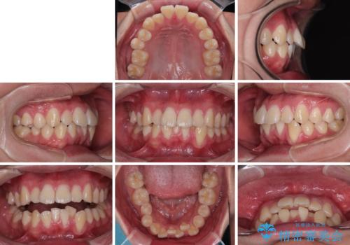 全体的なデコボコをスッキリと ワイヤー装置での抜歯矯正の治療前