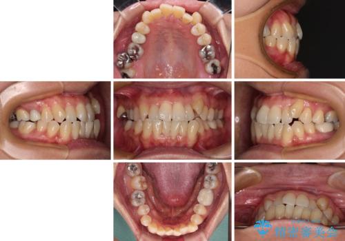 受け口と八重歯を改善　インビザライン矯正治療の治療前