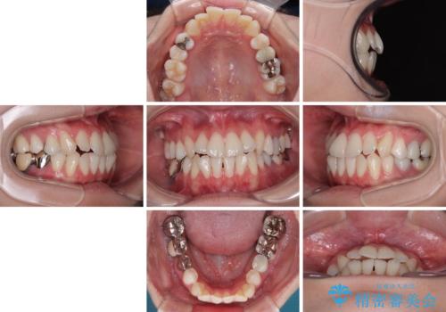 【モニター】前歯のデコボコをインビザラインで綺麗にの治療前