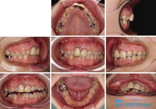 前歯のデコボコをワイヤー矯正で綺麗に 保険診療の前歯クラウンもセラミッククラウンで自然にの治療前