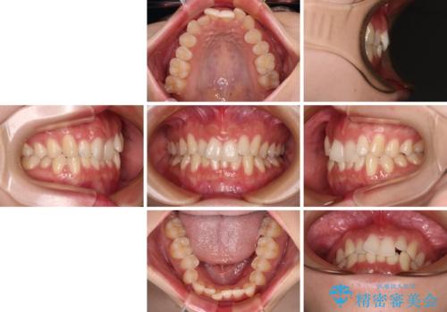 前歯が隠れるほどのデコボコをインビザライン矯正できれいに整えるの治療前