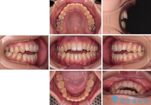 【モニター】食事が取りづらい　極端な開咬をインビザラインで解決の治療前