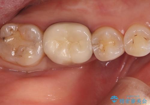 【セラミックインレー】歯の奥側に虫歯ができてしまったの治療前