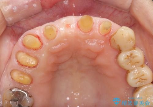 [ 再生療法 ]  歯周病治療を行った前歯のセラミック治療の治療中
