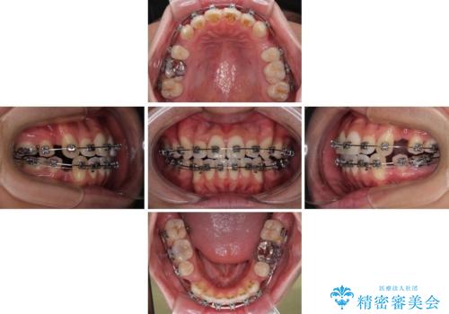 口が閉じにくい原因を根本から改善|上下顎4本抜歯による矯正治療症例の治療中