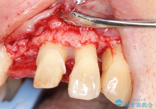 [ 再生療法 ]  歯周病治療を行った前歯のセラミック治療の治療前