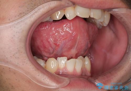 【舌小帯切除】ら行が言いづらいの治療後