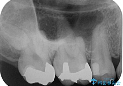 銀歯を金歯にしたい　ゴールドインレーの治療前