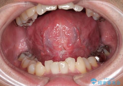 【舌小帯切除】ら行が言いづらいの症例 治療後