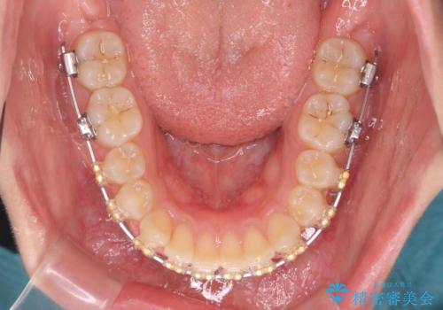 深い噛み合わせ、すきっ歯の改善　ワイヤーを用いたマルチブラケット矯正の治療中