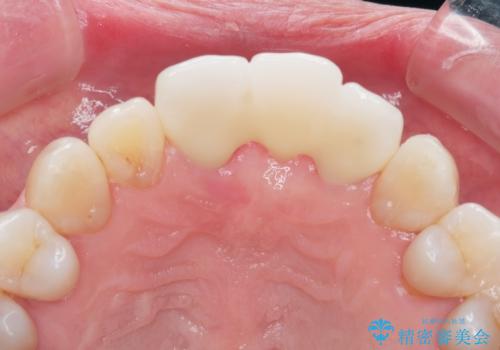 [ 欠損部の著しい骨欠損 ]　歯ぐきのボリュームを回復し自然なブリッジ作製治療の治療後