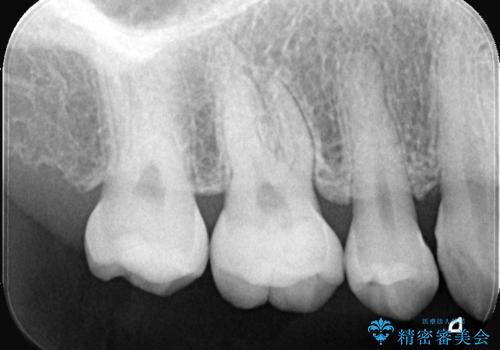 見逃しやすい小さな穴も精密に修復。自然な見た目のセラミックインレーの治療前