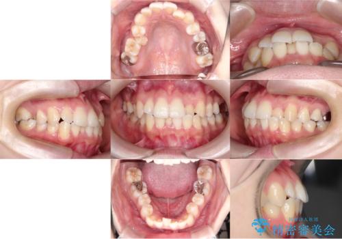 【ワイヤー矯正】口元を下げたい、下の歯の凹凸を無くしたいの治療前