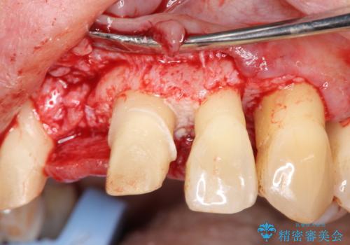 [ 再生療法 ]  歯周病治療を行った前歯のセラミック治療の治療前