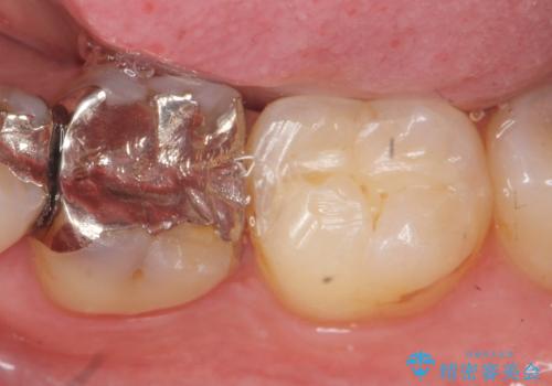 [ セラミック治療 ]  清掃性の悪い修復物を改善の治療前
