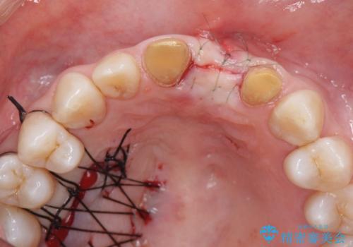 [ 欠損部の著しい骨欠損 ]　歯ぐきのボリュームを回復し自然なブリッジ作製治療の治療中