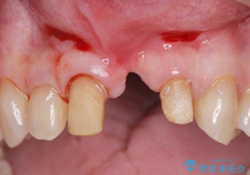 [ 欠損部の著しい骨欠損 ]　歯ぐきのボリュームを回復し自然なブリッジ作製治療の治療中