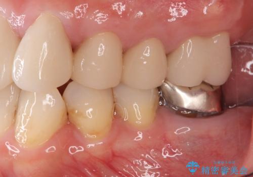 歯ブラシのしやすいクラウンへのやりかえの治療後