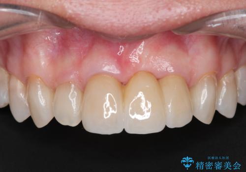 [ 欠損部の著しい骨欠損 ]　歯ぐきのボリュームを回復し自然なブリッジ作製治療の症例 治療後