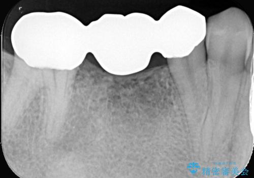 ブリッジからインプラントへの移行と歯周形成外科の治療前