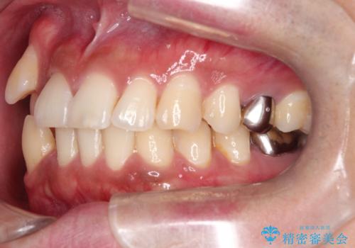 【ワイヤー矯正】八重歯と下の歯の凸凹を治したいの治療前