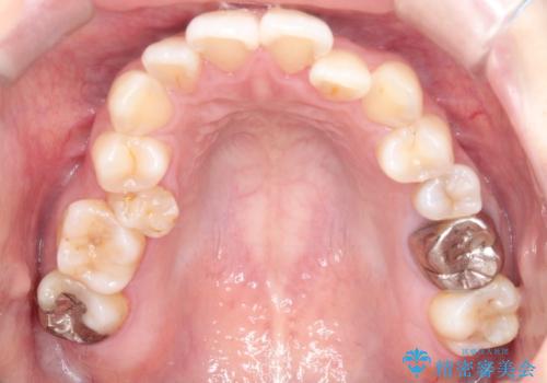 【ワイヤー矯正】口元を下げたい、下の歯の凹凸を無くしたいの治療前