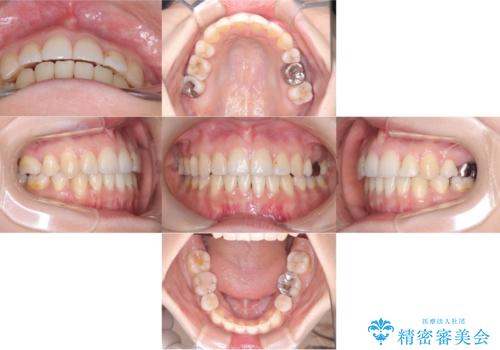 【ワイヤー矯正】口元を下げたい、下の歯の凹凸を無くしたいの症例 治療後