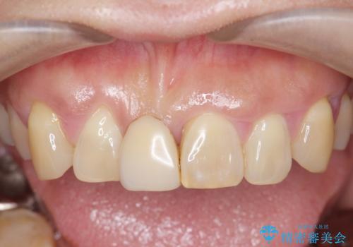 [ 再生療法 ]  歯周病治療を行った前歯のセラミック治療の治療前